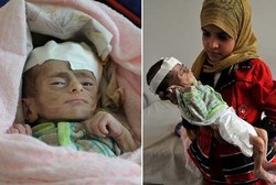 Bayi-bayi di Yaman Mukanya Keriput Karena Kurang Gizi