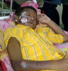 Asyik Main Mercon, 6 Bocah SD Terkena Luka Bakar