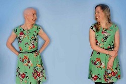 Kembar Identik Walau Satu Botak Satu Berambut