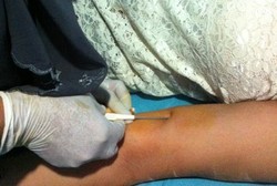 Implan KB Hilang di Dalam Tubuh, Banyak Wanita Inggris Gagal Jadi Ibu