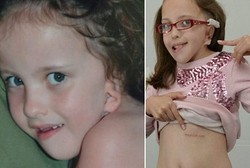 Setelah Menunggu 9 Tahun Bocah Perempuan Ini Akhirnya Punya Telinga