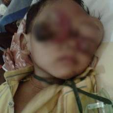 Bola Mata Rusak, Irsyad Tunggu Pemeriksaan Diagnostik Dokter