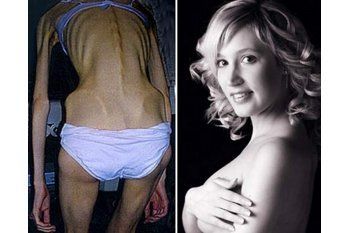 Perempuan-perempuan yang Kurusnya Kelewatan