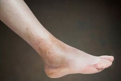 Pertolongan Pertama Untuk Memar