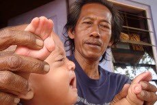 Bayi dengan Jari Dempet Ini Butuh Bantuan Biaya Operasi