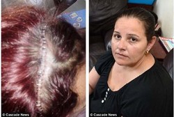 Hampir Mati Karena Otak Dipenuhi Larva Cacing Pita