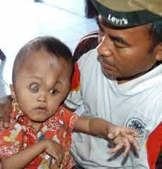 Bocah 6 Tahun Penderita Hydrocephalus Merengek Minta Sekolah & Ngaji