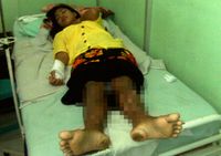 Aneh! Tubuh Supiyati Dipenuhi Jarum & Paku