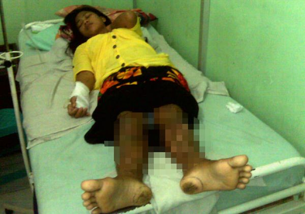 Aneh! Tubuh Supiyati Dipenuhi Jarum & Paku