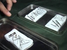 69 Jarum dan Paku Diangkat dari Kaki Supiyati