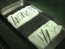 75 Jarum Sukses Dikeluarkan, Benda Asing Kembali Muncul di Kaki Supiyati