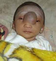 Seorang Bayi Penderita Tumor Butuh Pengobatan