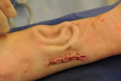 Dokter Berhasil Tumbuhkan Daun Kuping di Lengan Pasien