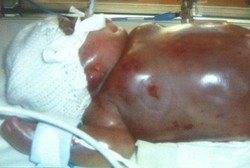 Hanya Bertahan Hidup 2 Hari Akibat Sindrom Menampar Pipi