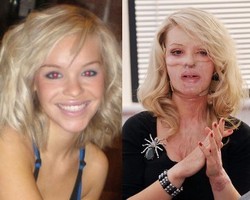 Kisah Model Cantik yang Wajahnya Hancur Dirusak Mantan Kekasih