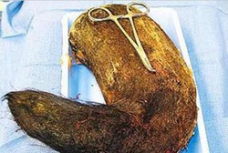 Seram! 1,8 Kg Rambut Dikeluarkan dari Perut sang Gadis
