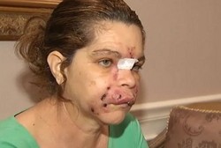 Suntik Wajah Biar Awet Muda, Jadinya Malah Codet-codet