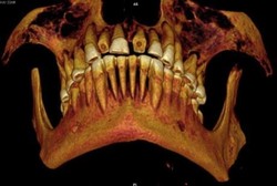 Mumi yang Meninggal Karena Tak Tahan Menanggung Sakit Gigi