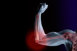 Pertolongan Pertama pada Patah Tulang