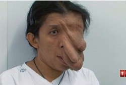 Perempuan Murah Hati dengan Separuh Tumor Raksasa di Wajahnya