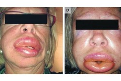 Penyakit Langka Menyebabkan Wajah Membengkak Selama 10 Tahun