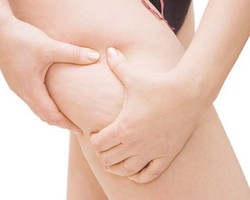 Selulit Terjadi Pada 85% Wanita, Ini Penyebabnya!