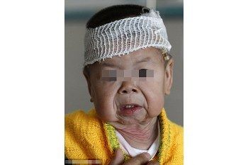 Kalau Kena Sindrom Ini, Bayi pun Jadi Keriput Seperti Nenek-nenek