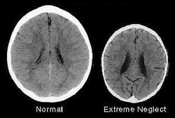 Bayi yang Tak Dapat Kasih Sayang Otaknya Kurang Berkembang