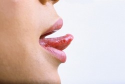 Lidah Pendek, Kondisi Terbatasnya Ruang Gerak Lidah