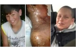 Kulit Bocah Ini Hampir Mengelupas Gara-gara Obat Penurun Demam