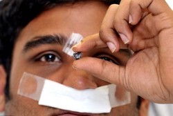 Tertembak di Dahi, Tapi Peluru Keluar dari Hidung