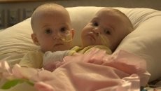 Usia 8 Bulan, Bayi Kembar Siam Berhasil Dipisahkan di AS