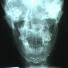 Puluhan Jarum di Kepala Pemuda Blitar Diduga Akibat Guna-guna