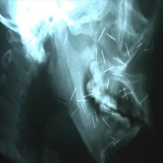 Hi... Kepala Pemuda Ini Dipenuhi Jarum