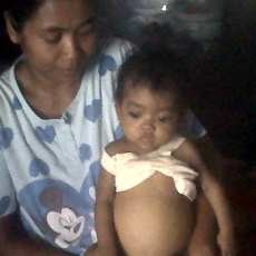 Bayi 10 Bulan Butuh Transplantasi Hati