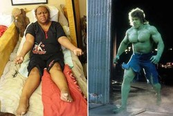 Wanita Hulk, Tubuhnya Bisa Tiba-tiba Membengkak karena Kondisi Langka