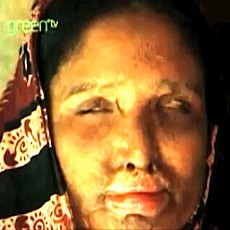 Sudah Disiram Air Keras, Wanita Ini Dipaksa Rujuk dengan Mantan Suami