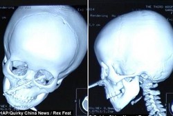 Astaga! Hidung Gadis Ini Bolong Tertusuk Obeng