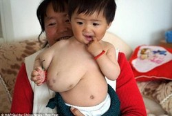 Balita Malang yang Terlahir dengan Tumor Berukuran Separuh Tubuhnya