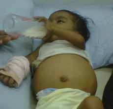 Dokter Stabilkan Kondisi Tubuh Penderita Atresia Billier Banyuwangi