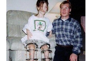 Terlahir Kerdil, Perempuan Ini Jalani Operasi Panjangkan Kaki