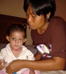 Kesehatan Putri Mantan Juara Dunia Perahu Naga Membaik, Butuh Biaya Operasi