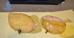 Astaga! Implan Payudara Wanita Ini Terbuat dari Kokain