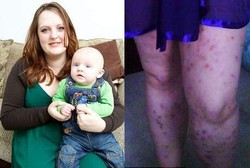 Kulit Melepuh Saat Hamil, Ternyata Ibu Ini Alergi Janinnya Sendiri 