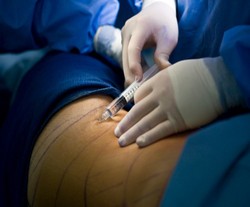  Kondisi Seperti Apa Orang Butuh Liposuction & Tummytuck?