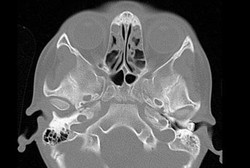 Duh! Gigi Bersarang di Telinga Bocah Ini Selama 3 Tahun