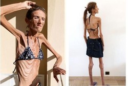 Wanita Terkurus di Dunia, Tubuhnya Hanya Tinggal Tulang Belulang