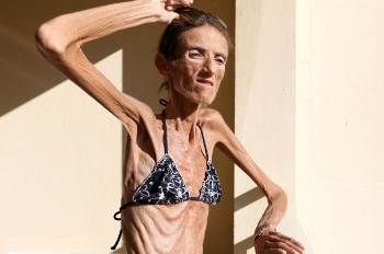 Valeria Levitin, Wanita Paling Kurus di Dunia