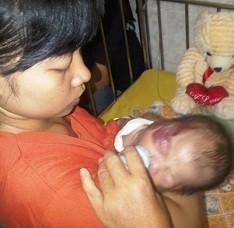 Bayi 3 Bulan Asal Kukar Derita Tumor Pembuluh Darah