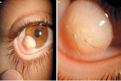 Seram! Tumbuh Rambut di Bola Mata Gara-gara Tumor